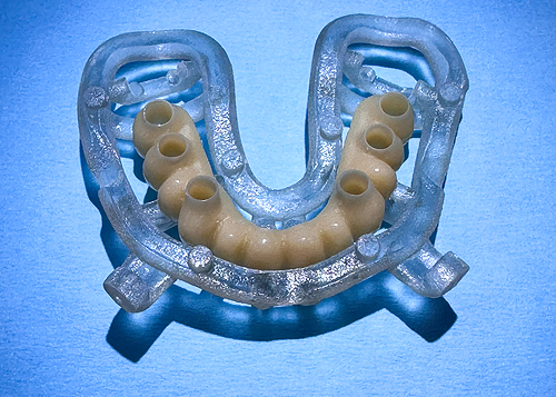 Guide chirurgical de précision pour la pose d’implants dentaires par ordinateur