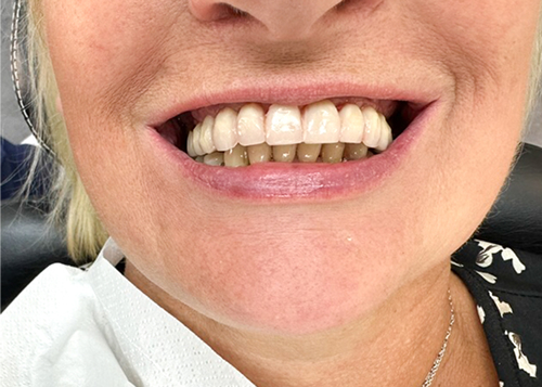 Résultat final : prothèse dentaire fixe sur implants pour un sourire esthétique
